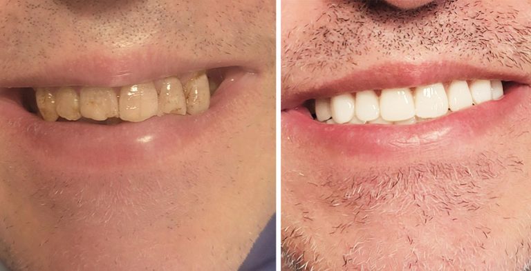 Prima e dopo trattamento implantologia dentale